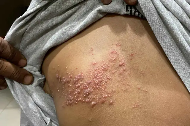 Półpasiec: Jak długo brać leki? 7-10 dni i uniknij neuralgii!