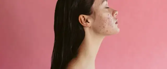 Jak zmniejszyć zaczerwienienie pryszcza i poprawić wygląd skóry