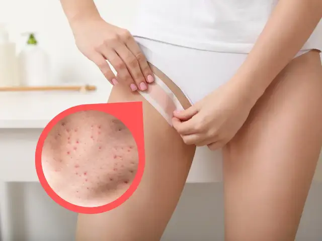 Jak pozbyć się kropek po goleniu - skuteczne sposoby na ulgę i zapobieganie