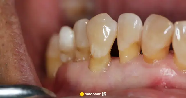 Recesja dziąseł: Czy dziąsła odrosną? Odbudowa krok po kroku