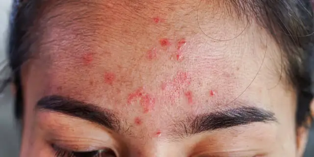 Pryszcze na czole: Co oznaczają i jak się ich pozbyć?