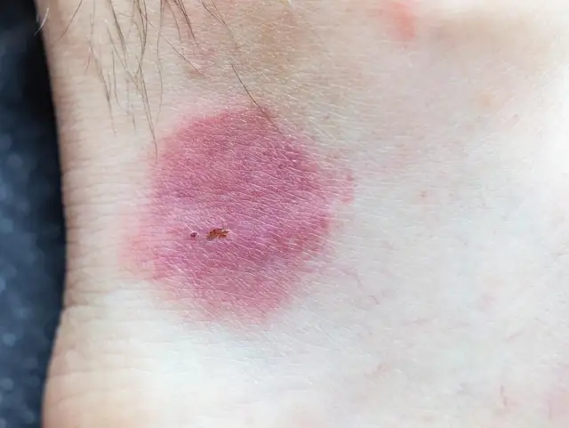 Objawy ugryzienia pająka: jak rozpoznać niebezpieczne symptomy