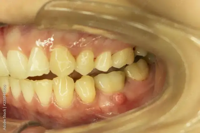 Antybiotyk na ząb z ropą: kiedy i jaki lek? Wizyta u dentysty.