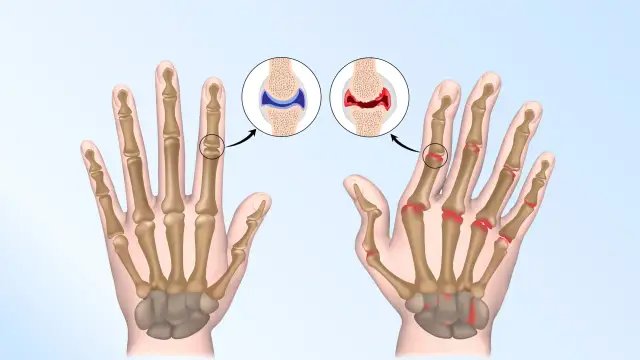 Ból stawów dłoni? Ulga, leczenie i ćwiczenia. Kiedy do lekarza?
