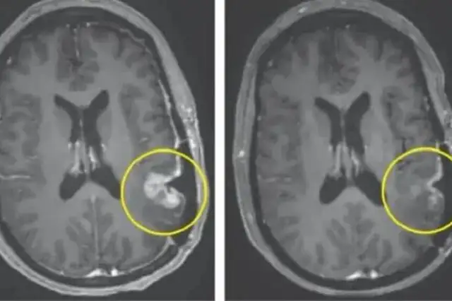 Jak odróżnić nerwicę od guza mózgu i uniknąć błędnej diagnozy