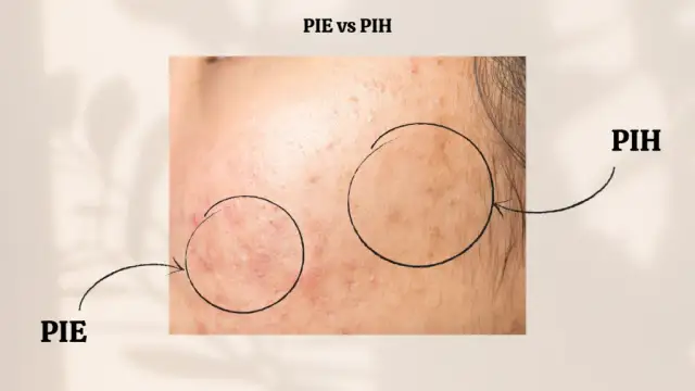 Czerwone plamy po pryszczach: Poznaj skuteczne sposoby na PIE!