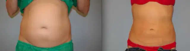 Czy liposukcja laserowa jest skuteczna? Efekty i ryzyko zabiegu