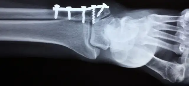 Skręcenie biodra: objawy, leczenie, jak odróżnić od złamania?