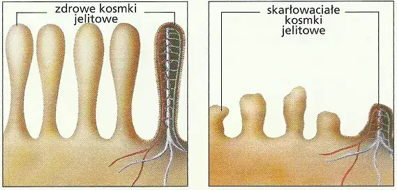 Nietolerancja glutenu: objawy, różnice, diagnoza i dieta