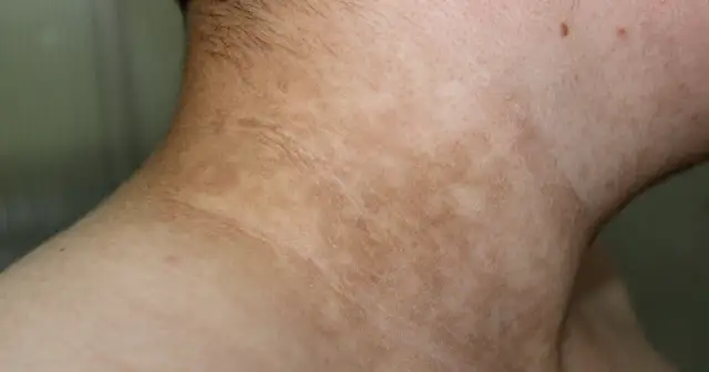 Zmiany skórne na szyi, przebarwienia i drobne krostki. Czy przy cukrzycy się chudnie? To pytanie nurtuje wiele osób.