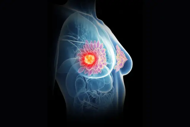 Wyczułaś guz w piersi? Jak szybko rośnie i co robić krok po kroku