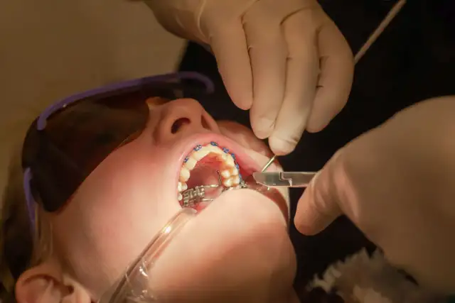 Zakładanie aparatu na zęby: Ile trwa i czego się spodziewać?
