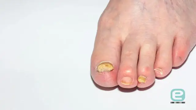 Czy to grzybica paznokci? Rozpoznaj objawy i różnice z innymi chorobami