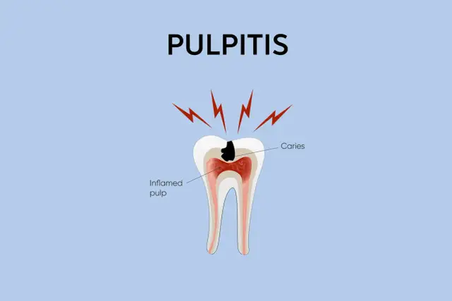 Zapalenie miazgi w zębie spowodowane próchnicą. Widoczny przekrój zęba z zapalonym wnętrzem i czarną próchnicą.