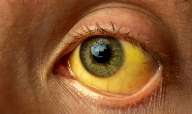 Podwyższona bilirubina: przyczyny, objawy i kiedy się martwić?