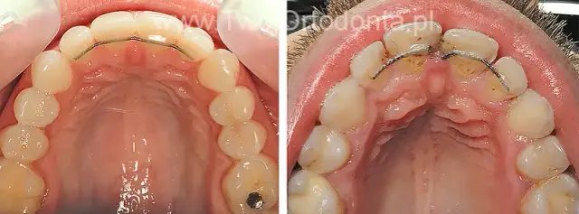 Ile nosi się aparat na zęby stały? Czas leczenia i retencja