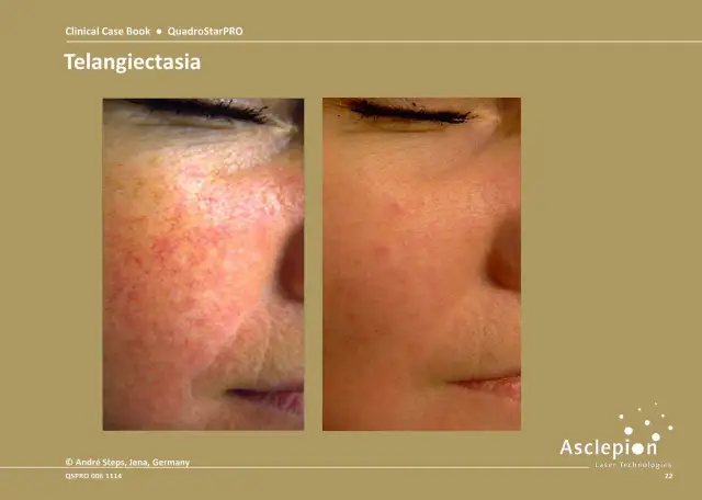 Przed i po laserowym usuwaniu rumienia. Skóra z widocznymi naczynkami przed zabiegiem i gładka po.