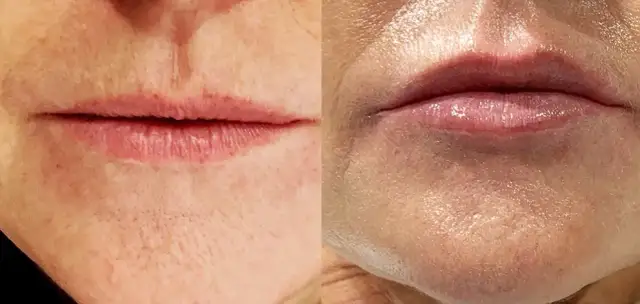 Jak długo utrzymuje się efekt kwasu hialuronowego w ustach?