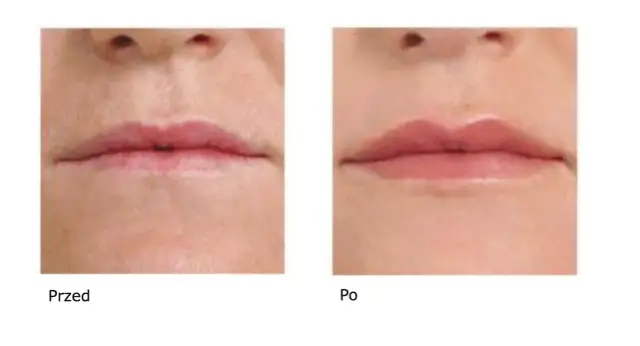 Ile utrzymuje się kwas hialuronowy na twarzy? Zaskakujące fakty o trwałości