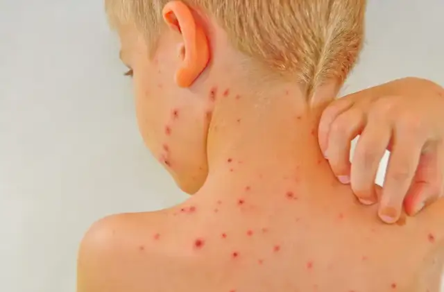 Jak zapobiec bostonce u dzieci i uniknąć zakażeń w rodzinie