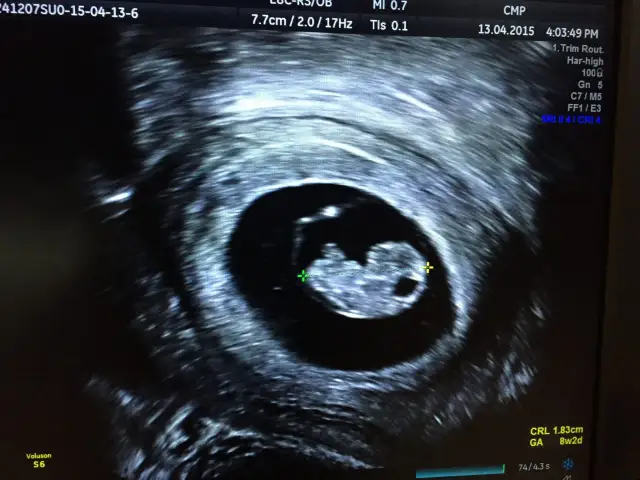 Kiedy USG wykryje ciążę? Sprawdź, co zobaczysz na wczesnym etapie