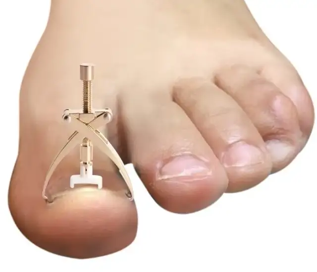 Klamra na paznokieć: jak długo? Od 6 miesięcy do 2 lat co wpływa?