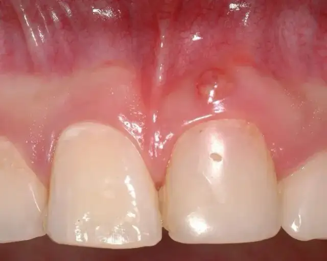 Zapalenie dziąseł u dziecka: Szybka ulga i kiedy do dentysty?