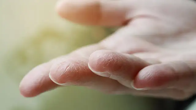 Suchy naskórek na palcach dłoni, schodząca skóra z dłoni.