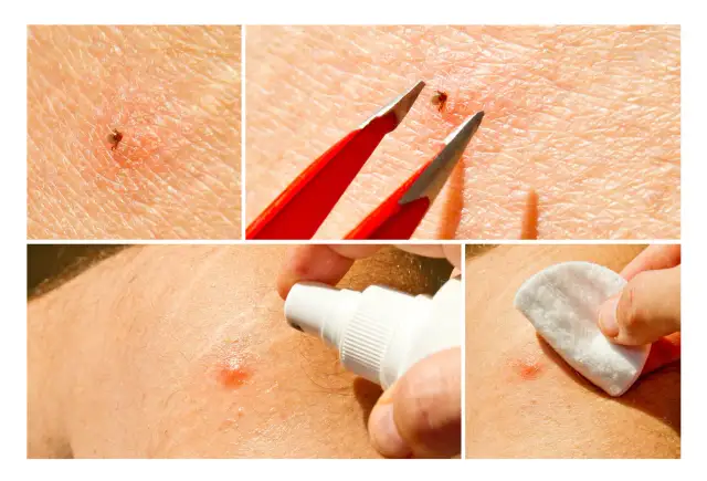 Czy ugryzienie kleszcza swędzi? Objawy i jak sobie z nimi radzić