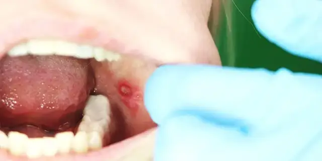 Czy z aftą można iść do dentysty? Sprawdź, czy to bezpieczne i co warto wiedzieć