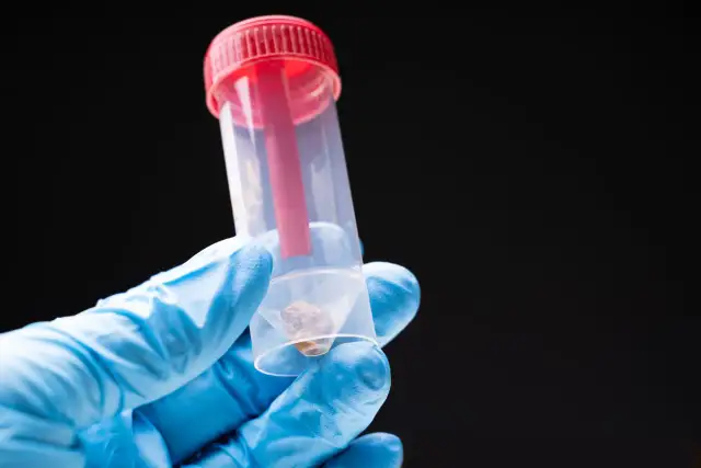 Jak prawidłowo pobrać stolec do badania? Uniknij błędów!