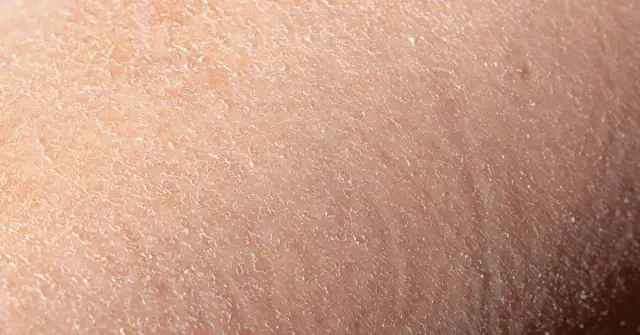 Ursachen und Lösungen für trockene schuppige Gesichtshaut verstehen