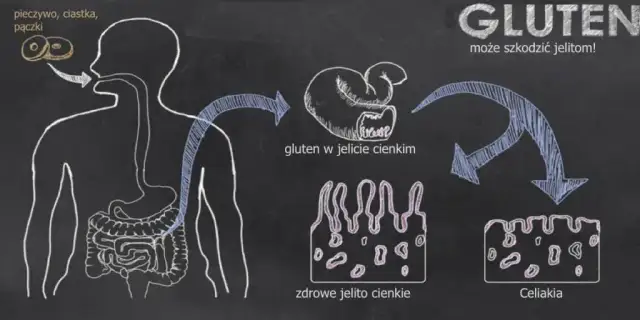 Gluten: co to jest? Objawy, diagnostyka. Czy musisz go unikać?