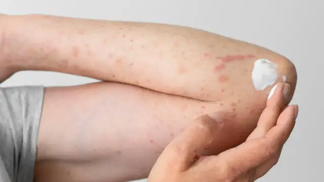 Skaza białkowa czy potówki? Rozpoznaj i pomóż maluchowi!