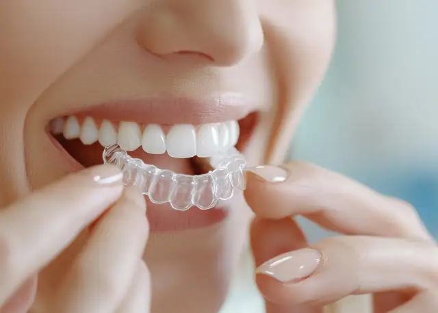 Nakładka po aparacie: Ile kosztuje i jak utrzymać prosty uśmiech?