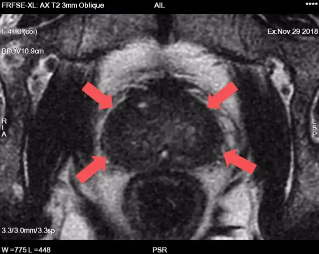 Rezonans prostaty: Jak wykryć raka? Skuteczność i wskazania