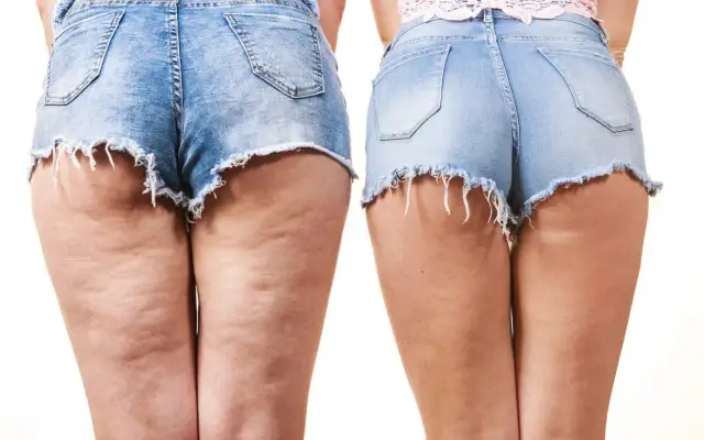 Cellulit na udach: Kompleksowy plan na gładką skórę!