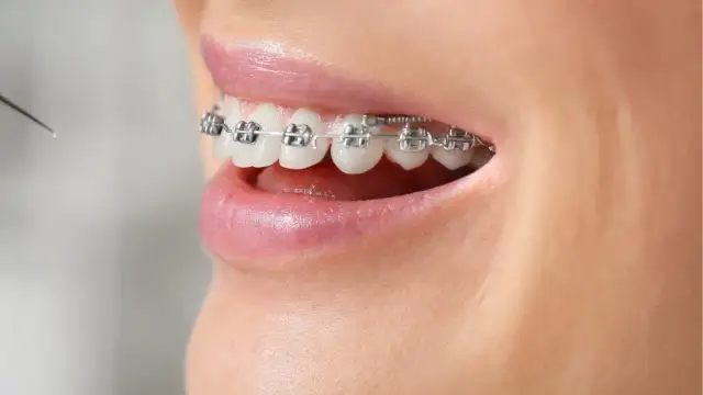 Ile nosić aparat na zęby? Średni czas i jak skrócić leczenie