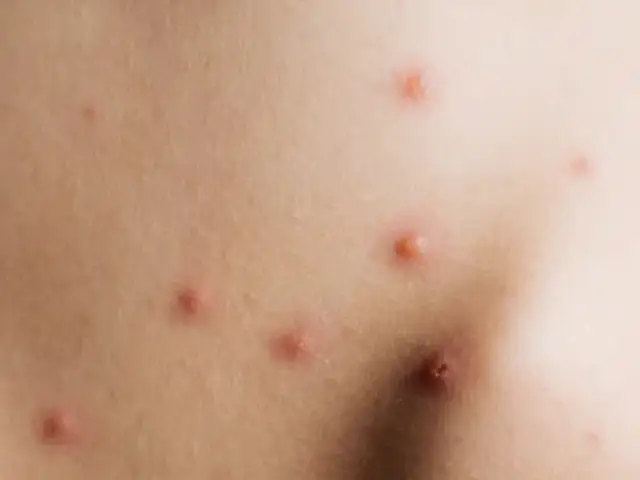 Piel con varias picaduras rojas e inflamadas, algunas con un punto central.