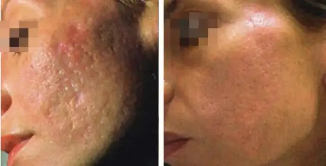 Ile zabiegów laserem frakcyjnym CO2 potrzebujesz dla najlepszych efektów?