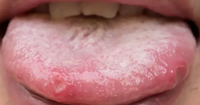 Objawy cukrzycy w jamie ustnej – jak je rozpoznać i co zrobić, by je złagodzić