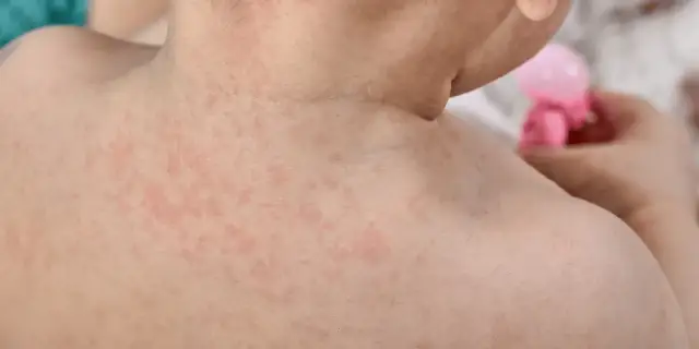 Trzydniówka u dziecka: Kiedy gorączka spada, a wysypka się pojawia?