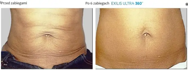 Jak pozbyć się brzucha po porodzie: 8 skutecznych metod