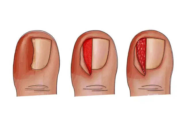 Jak pozbyć się wrastającego paznokcia - skuteczne metody i porady