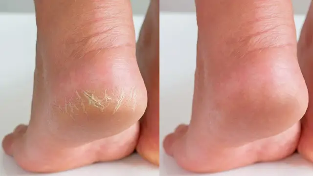 Przed i po: pięta z pęknięciami i sucha skóra, a obok gładka, nawilżona. Idealne rozwiązanie co na suche pięty.