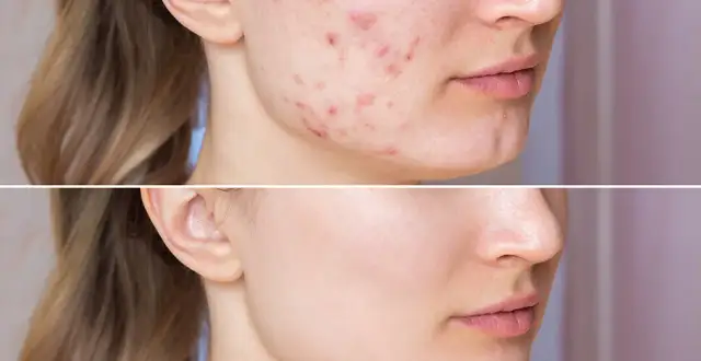 Jak poprawić stan cery trądzikowej i odzyskać zdrowy wygląd skóry