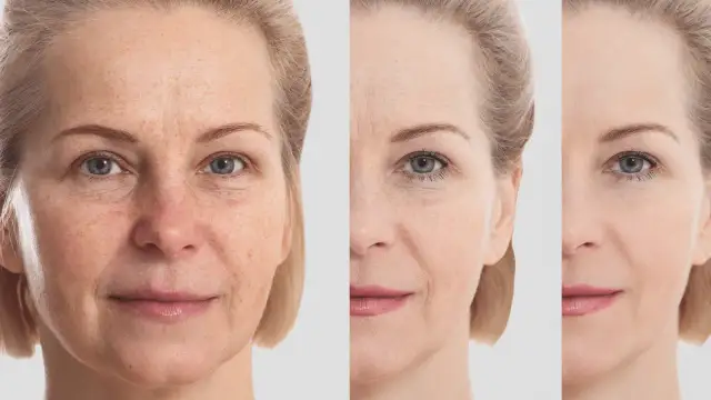 Skuteczne metody na pozbycie się pryszczy na czole i poprawę skóry