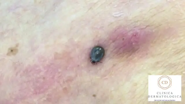 Opity kleszcz po 24h: Jak wygląda, co oznacza i jak go usunąć?