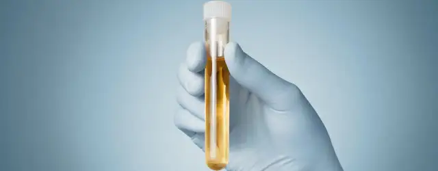 Gdzie trzymać mocz przed badaniem, aby uniknąć błędów w wynikach?