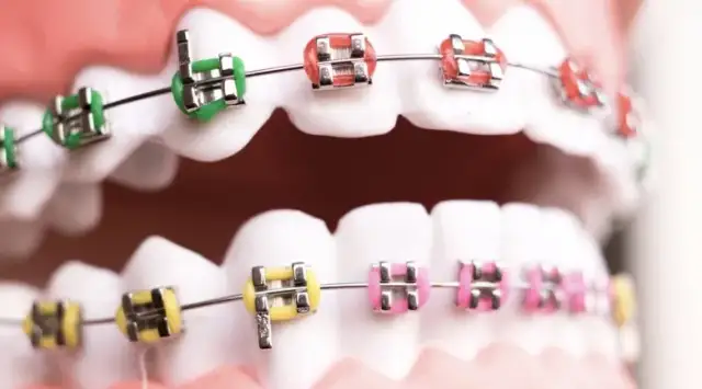 Jaki aparat na zęby? Poradnik: stałe, ruchome, ceny, wybór